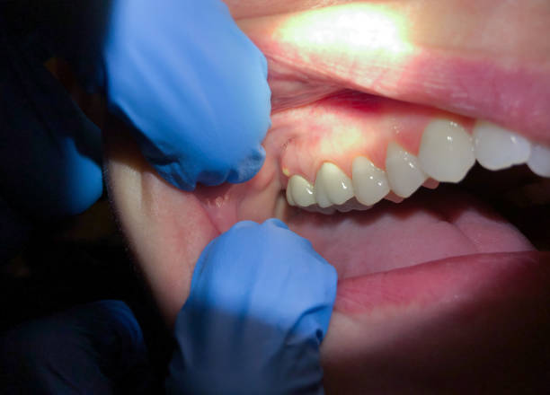Best Teeth Whitening  in Fredonia, WI
