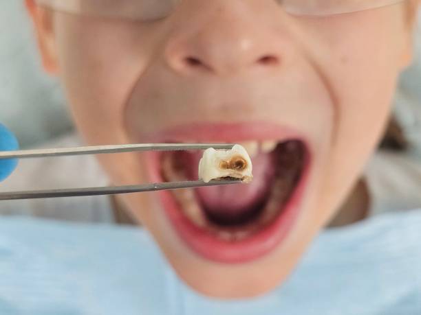 Best Tooth Infection Emergency Dentist  in Fredonia, WI